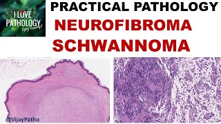 NEUROFIBROMA AND SCHWANNOMA Clinical features amp Morphology [upl. by Omrelliug]