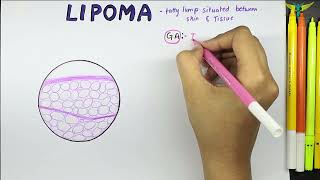 Lipoma Histopathology  Benign Mesenchymal tumor Histopathology  Gross  Microscopy [upl. by Ynattib]