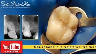 perawatan saluran akar pada gigi molar 2 rahang atas endodontic treatment [upl. by Esemaj109]