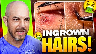 The Truth About Ingrown Hairs  Doctor Explains Causes amp Fixes [upl. by Anastasie]