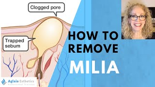 HOW TO REMOVE A MILIA STEP BY STEP  NATURALLY [upl. by Sinoda]