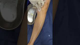 Knee cyst aspiration and injection procedure [upl. by Virgilio857]