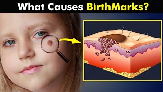 Birthmarks  How Birth Marks Develops In Our Skin UrduHindi [upl. by Acinahs]