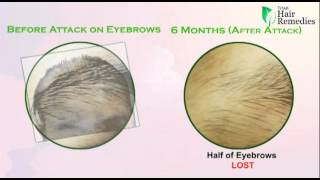 Eyebrows Alopecia Areata [upl. by Vyky729]