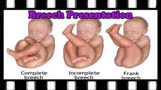 ICD9 Coding Question — 65221 Code amp Breech Birth Explained [upl. by Walters]