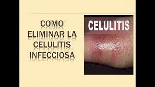 3 CONSEJOS DE COMO ELIMINAR LA CELULITIS INFECCIOSA 😍 como TRATAR la celulitis infecciosa [upl. by Akinek]