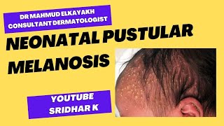 Neonatal pustular melanosisa dermatologists perspective rash newbornrash pustularmelanosis [upl. by Peery667]