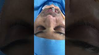 Radix and alar base reduction nose contouring surgery [upl. by Ailemac]