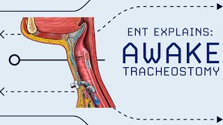 Awake Tracheostomy Explained Emergency Airway in OR [upl. by Annairoc600]