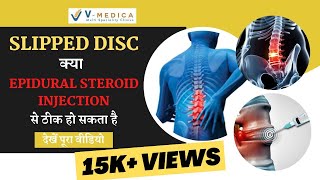 Lumbar Epidural Steroid Injection For Slipped Disc  Dr Ashish Yadav  Spine Surgeon [upl. by Meda471]