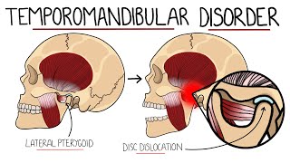 Temporomandibular Joint Disorder Explained TMJ Dysfunction  Includes Treatment amp Anatomy [upl. by Maidie]