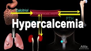 Hypercalcemia  Too Much Calcium Animation [upl. by Tiffany]