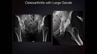 Radiography of Arthritis 2018 Refresher [upl. by Ripley]