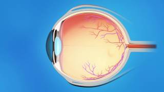 Laser Trabeculoplasty for Glaucoma [upl. by Eizus128]