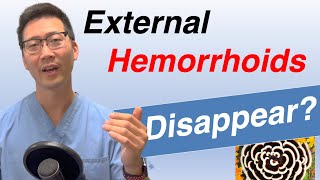 Can External hemorrhoids go away on their own Does treatment matter [upl. by Garnet]