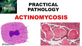 Practical Pathology ACTINOMYCOSIS [upl. by Anadal]