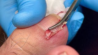 SATISYING INGROWN TOENAIL REMOVAL 😎 [upl. by Chassin639]