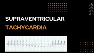 Supraventricular Tachycardia  SVT [upl. by Ahseetal]