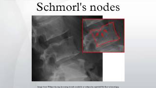 Schmorls nodes [upl. by Arreyt]