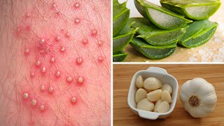 7 Powerful Home Remedies to Get Rid of Folliculitis [upl. by Helbonna]