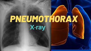 How to identify Pneumothorax in Chest Xray [upl. by Larred]