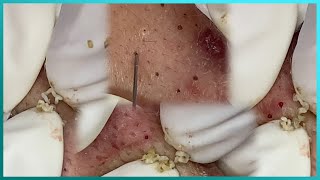 Big Cystic Acne Blackheads Extraction Blackheads amp Milia Whiteheads Removal Pimple Popping [upl. by Marne]