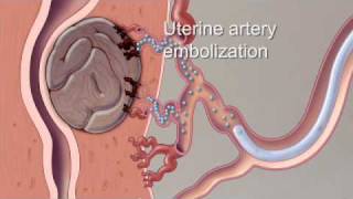 Shrink FIBROIDS Little Known Scientific Fix 2024 [upl. by Farl194]