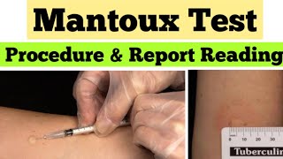 Mantoux Test in Hindi  Tuberculin Skin Test  mantoux test results reading [upl. by Ydnim]