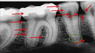 Radiographie rétro  alvéolaire [upl. by Yklam]