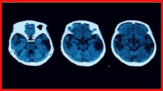 Atrophie corticale postérieure  diagnostic et traitement [upl. by Revned]