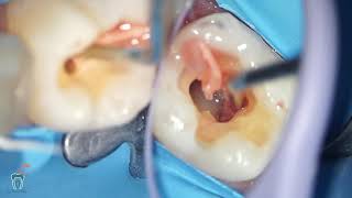 inside a tooth ischemic nerve [upl. by Rosenblatt914]