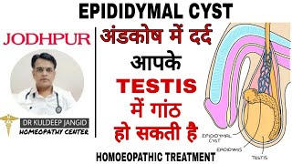 Epididymal cyst in testis treatment with homoeopathy । अंडकोष की गांठ का बिना ऑपरेशन इलाज । [upl. by Furnary]