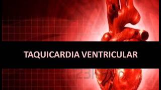 Arritmias cardíacas  Taquicardia ventricular [upl. by Iahc]