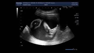 Ultrasound Video showing the case of Anencephaly [upl. by Jezebel157]