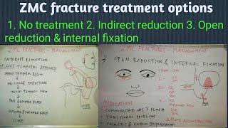 ZMC FRACTURES  MANAGEMENT [upl. by Kym]