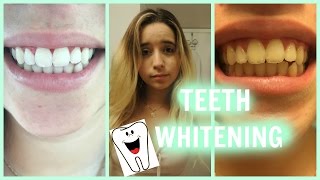 TEETH WHITENING TUTORIAL  PHILIPS ZOOM DAY WHITE [upl. by Sairahcaz]