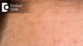 What is Hyperpigmentation and how to treat it  Dr Jyoti Jha [upl. by Gothurd]