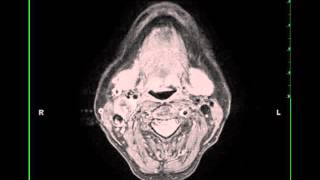 Glomus Tumor 5Minute Pathology Pearls [upl. by Alyam18]