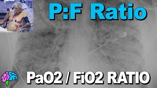 PaO2 to FiO2 Ratio  PF Ratio [upl. by Illek]