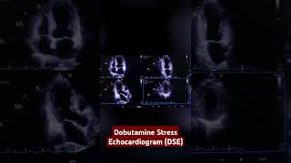 Can Echocardiography Detect Heart Blockages [upl. by Atsillak953]