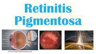 Retinitis Pigmentosa  Genetics Pathophysiology Signs amp Symptoms Diagnosis Treatment [upl. by Gaspar]