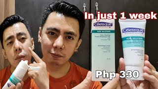 1 MONTH REVIEW OF CELETEQUE ACNE CLEARING FACIAL MOISTURIZER GEL  NABAWAS MALALAKING PIMPLES KO [upl. by Amimej]