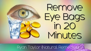 How To Remove Eye Bags 20 Minute Natural Remedies [upl. by Akinhoj961]