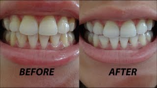 Crest 3D Whitestrips Vivid Before amp After Demo  Review [upl. by Arimas]