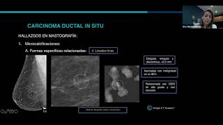 Carcinoma ductal in situ [upl. by Friedrick272]