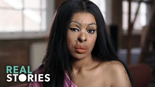 ACID ATTACK My Story Crime Documentary  Real Stories [upl. by Bettencourt626]