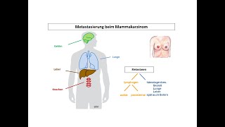 Metastasierung beim Mammakarzinom  Strahlentherapie Prof Hilke Vorwerk [upl. by Neliak]