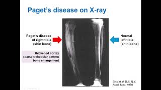 What is Paget’s Disease of Bone and how does bisphosphonate treatment work Dr Daroszewska explains [upl. by Daggett13]