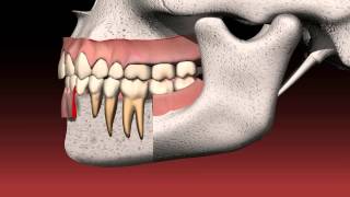 What is a dental bridge [upl. by Frame]