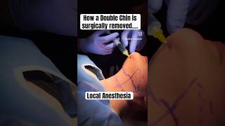 How to get rid of a double chin Austin Chin Lipo [upl. by Atelahs]